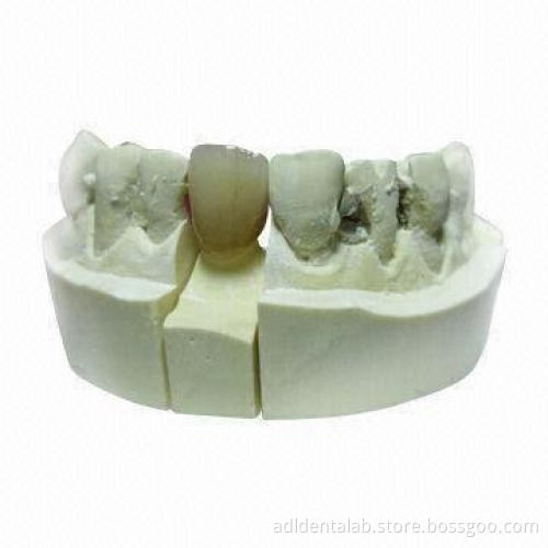 NP PFM Crown, Ideal for Long Span Bridges